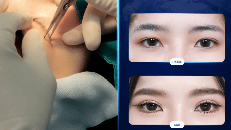 Khách hàng từng cắt mí trả góp tại Bệnh viện thẩm mỹ Sao Hàn