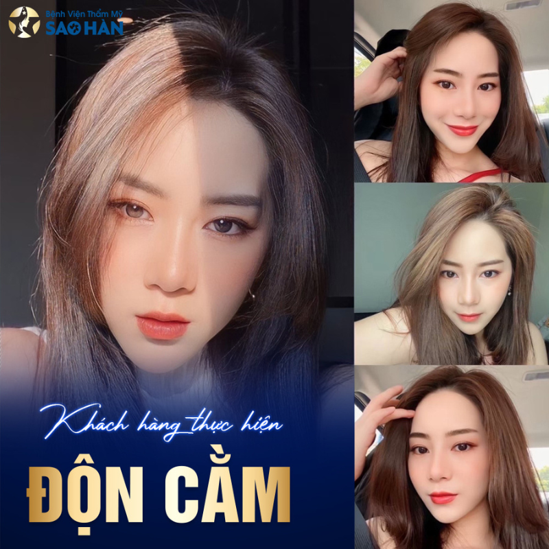 dịch vụ độn cằm tại bệnh sao hàn