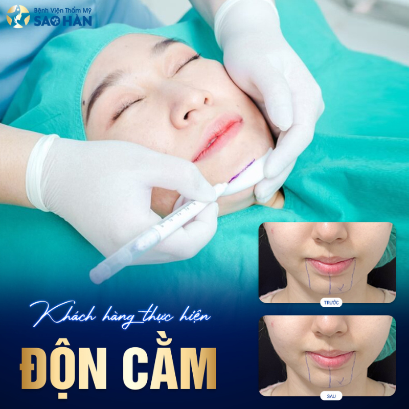 kinh nghiệm độn cằm vline nhanh hồi phục