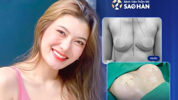 Nâng ngực tái tạo sau sinh tại bệnh viện Sao Hàn