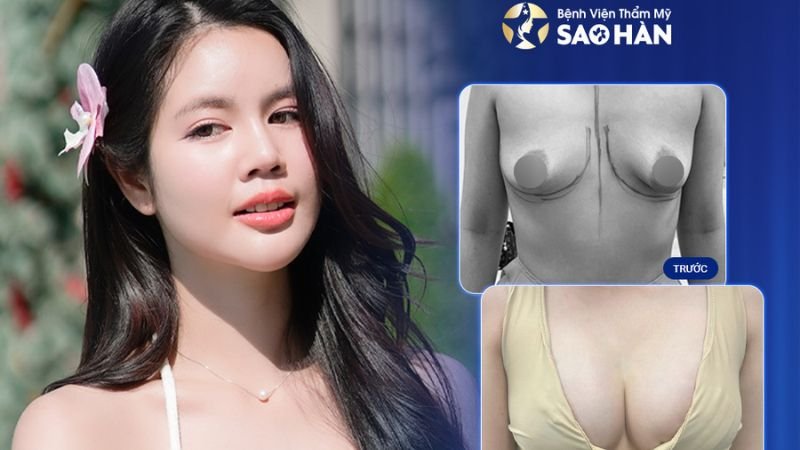 Nâng ngực tái tạo sau sinh tại bệnh viện Sao Hàn