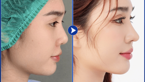 Nâng mũi sau bao lâu thì bình thường
