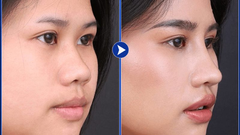Nâng mũi s line sụn tự thân hoàn toàn