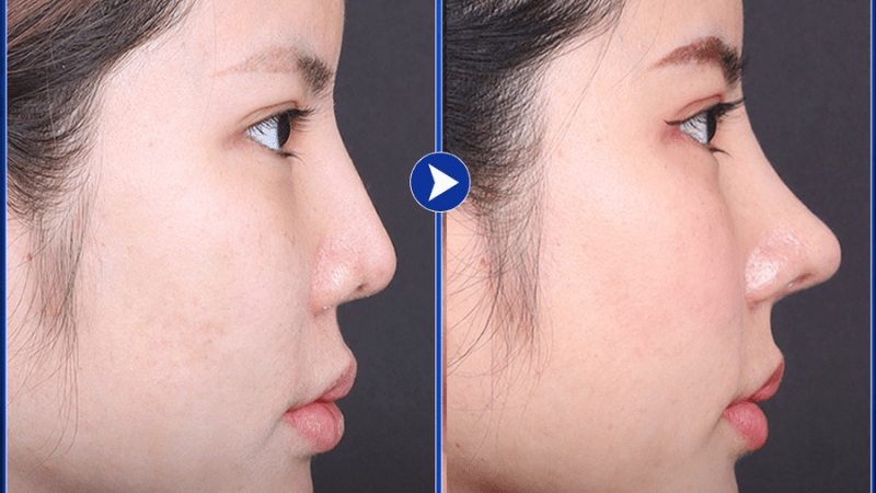 Nâng mũi s line sụn tự thân hoàn toàn