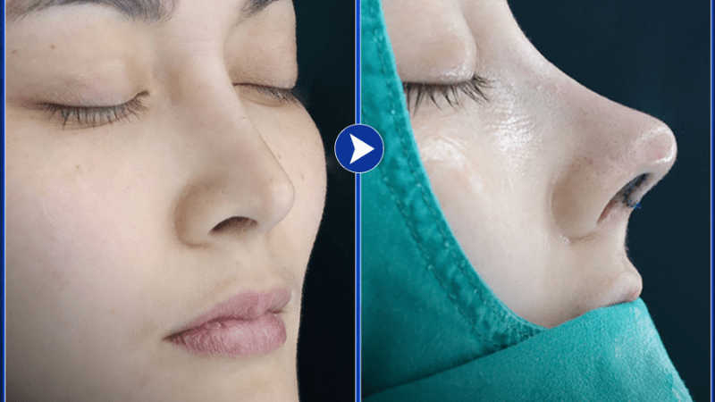 nâng mũi s-line bọc sụn prosil là gì
