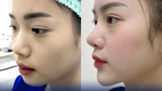 Nâng mũi s line sụn tự thân hoàn toàn