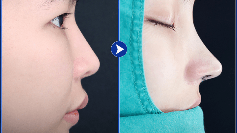 Nâng mũi sau bao lâu thì bình thường