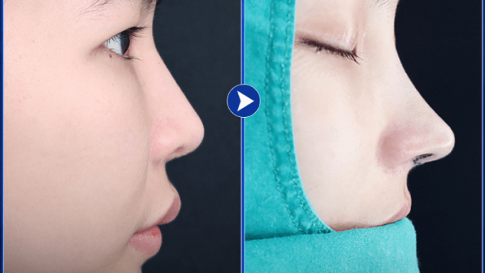 Nâng mũi sau 1 tháng bị sưng