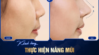 nâng mũi s-line bọc sụn prosil là gì