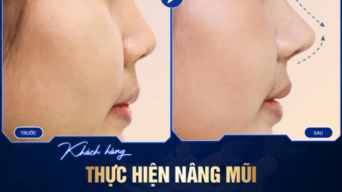 nâng mũi s-line bọc sụn prosil là gì