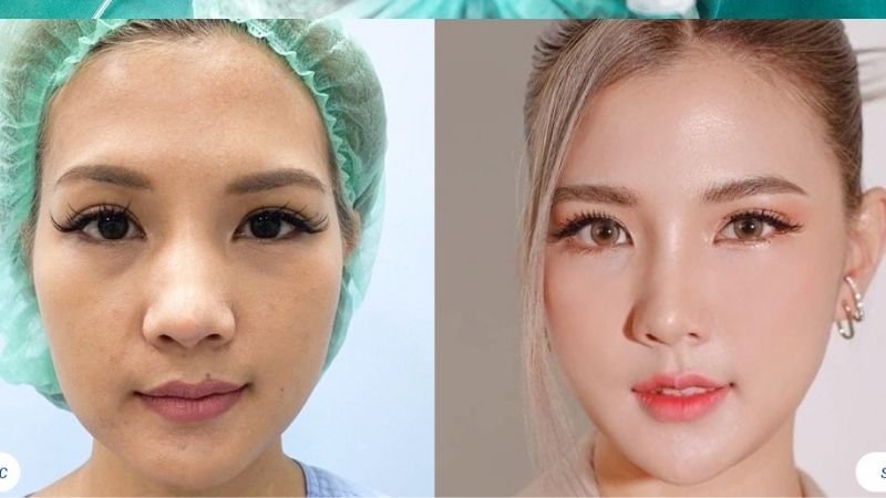 Hút mỡ cằm tại Bệnh viện Thẩm mỹ Sao Hàn