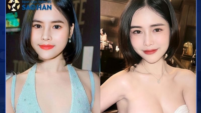 Hút mỡ cằm tại Bệnh viện Thẩm mỹ Sao Hàn