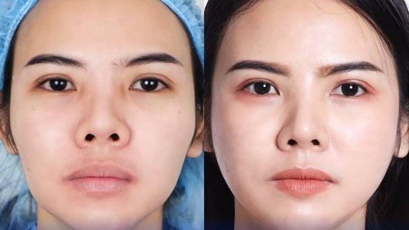 Chỉnh xương gò má cao tại bệnh viện thẩm mỹ Sao Hàn